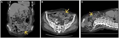 Acute complicated jejunum diverticulitis: a case report with a short literature review